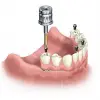 How Long Does Dental Implantation Take