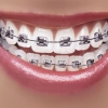 How Long Does It Take To Get Braces
