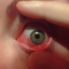 How Long Does Pink Eye Last