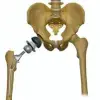 How Long Does A Hip Replacement Last