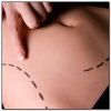 How Long Does It Take To Recover From Liposuction