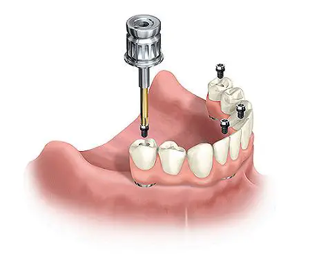 how long does dental implantation take