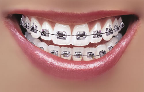 How Long Does It Take To Get Braces